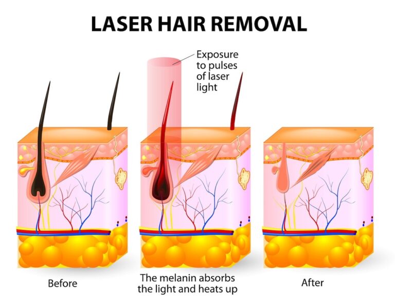 Light Blue Heat Hair Removal: How It Works - wide 2