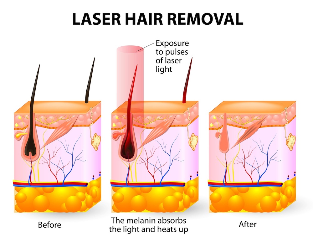 Laser hair removal. Vector diagram