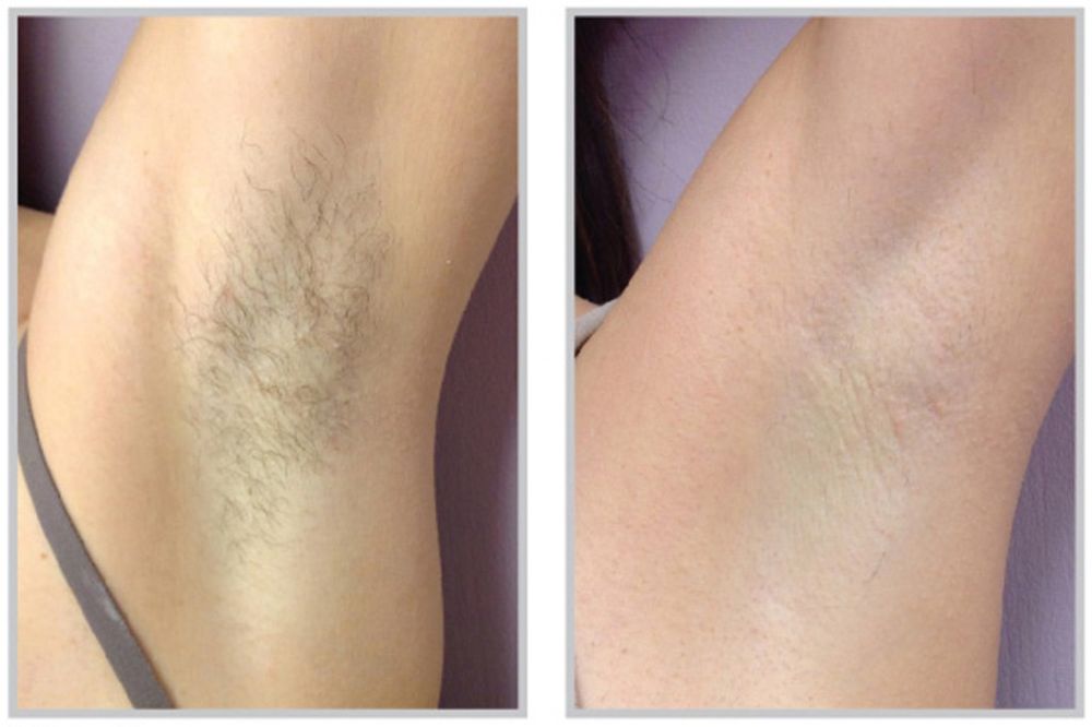 laser hair removal results