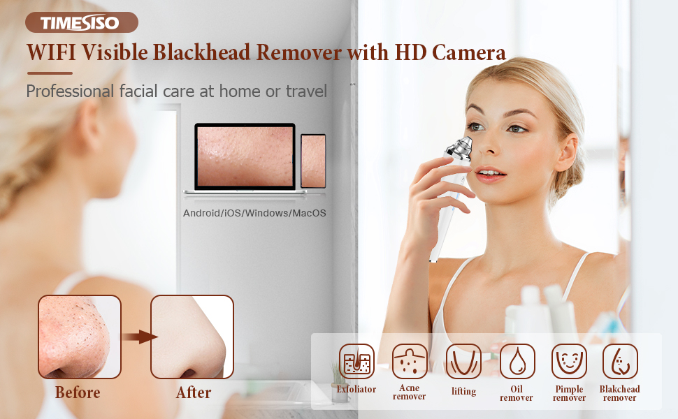 Time Siso Blackhead Remover