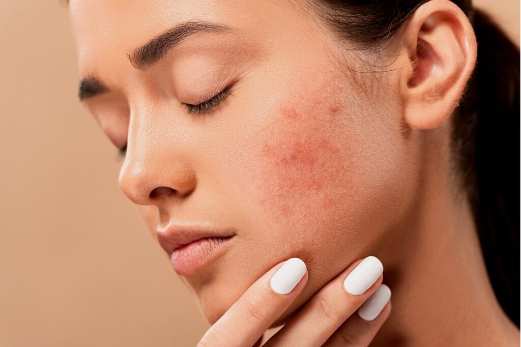 woman with pimples on cheeks